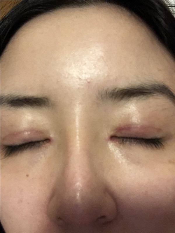 知道什么是睑缘微创吗?快进来看看我的双眼皮案例,术后不会有疤痕哦!!!