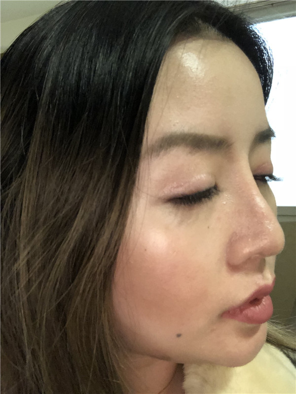 知道什么是睑缘微创吗?快进来看看我的双眼皮案例,术后不会有疤痕哦!!!
