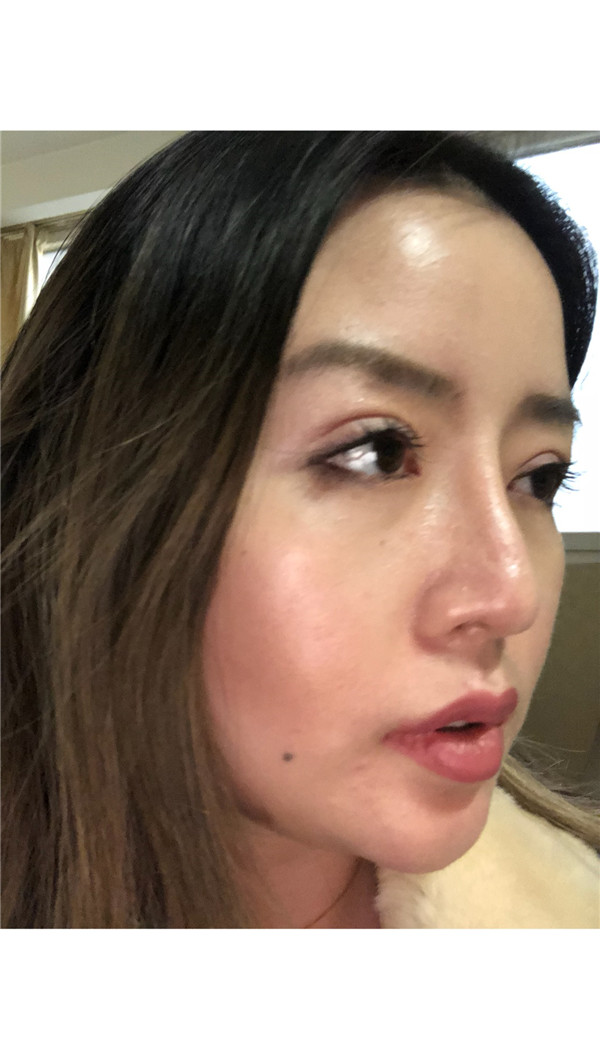知道什么是睑缘微创吗?快进来看看我的双眼皮案例,术后不会有疤痕哦!!!