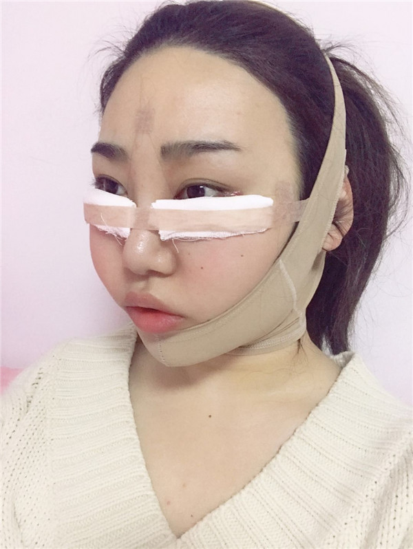 【自体脂肪面填两个月记录】我做自体脂肪面填两个月了!撒花!!!开心啊~所以一切的付出都不是白费的哦~~
