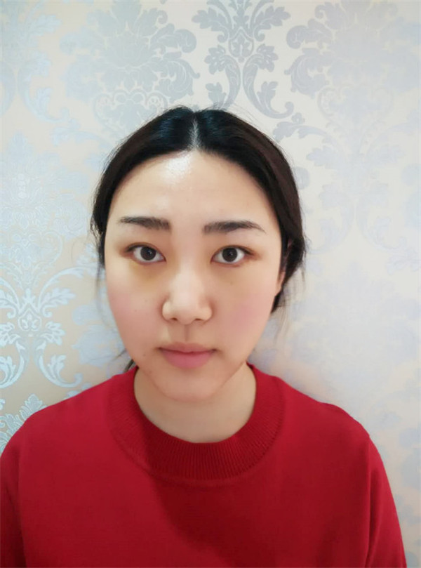 【自体脂肪面填两个月记录】我做自体脂肪面填两个月了!撒花!!!开心啊~所以一切的付出都不是白费的哦~~