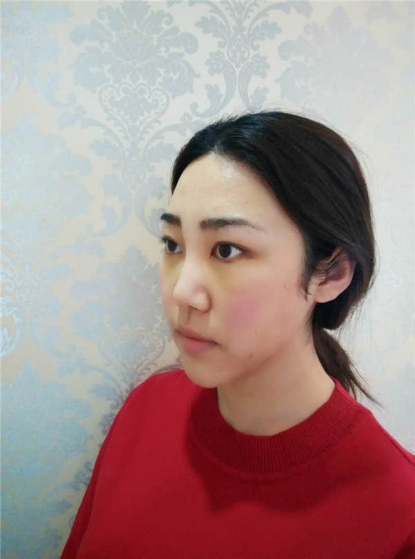 【自体脂肪面填两个月记录】我做自体脂肪面填两个月了!撒花!!!开心啊~所以一切的付出都不是白费的哦~~