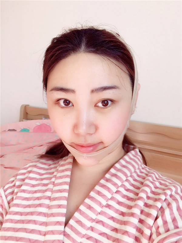 【自体脂肪面填两个月记录】我做自体脂肪面填两个月了!撒花!!!开心啊~所以一切的付出都不是白费的哦~~