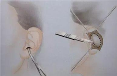 鼻部手术该用什么自体软骨才好?