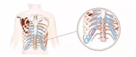 鼻部手术该用什么自体软骨才好?