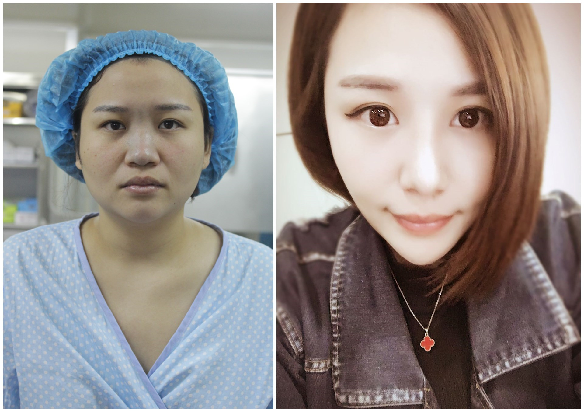 鼻部手术该用什么自体软骨才好?