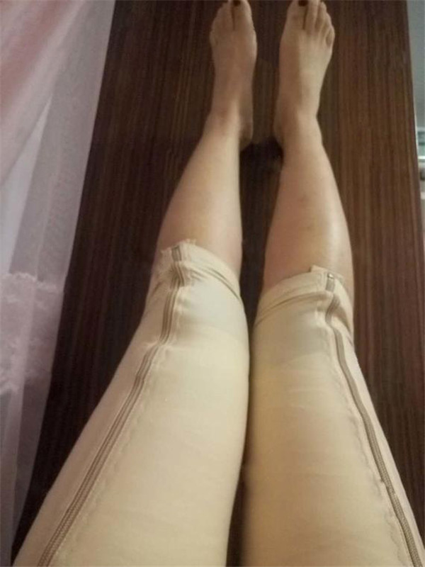姐妹们,给你们看看我的大腿吸脂案例!!恢复的挺好,快来看看我的一双筷子腿,瘦瘦的腿真好