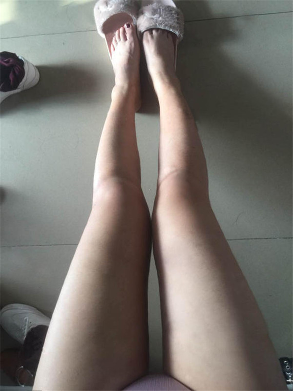 姐妹们,给你们看看我的大腿吸脂案例!!恢复的挺好,快来看看我的一双筷子腿,瘦瘦的腿真好