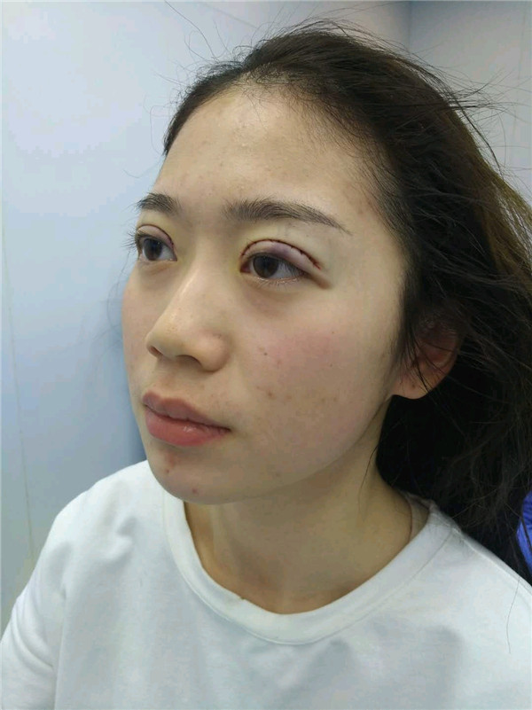 姐妹们,都来看看我的案例吧!!以前内双的眼皮晚上喝水喝得多第二天眼睛都会肿很久,现在拥有双眼皮之后再也不用担心了~~~
