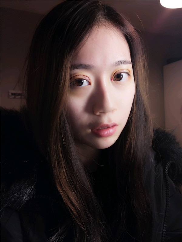 姐妹们,都来看看我的案例吧!!以前内双的眼皮晚上喝水喝得多第二天眼睛都会肿很久,现在拥有双眼皮之后再也不用担心了~~~
