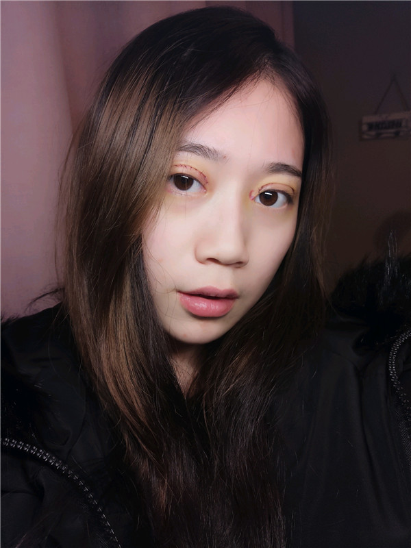 姐妹们,都来看看我的案例吧!!以前内双的眼皮晚上喝水喝得多第二天眼睛都会肿很久,现在拥有双眼皮之后再也不用担心了~~~