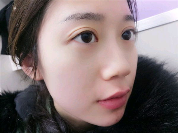 姐妹们,都来看看我的案例吧!!以前内双的眼皮晚上喝水喝得多第二天眼睛都会肿很久,现在拥有双眼皮之后再也不用担心了~~~