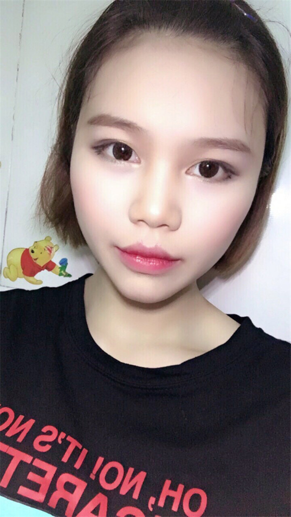 姐妹们,你们喜欢M唇吗?我做了M唇和自体脂肪填充额头,大家都来看看,觉得我做的怎么样呢?