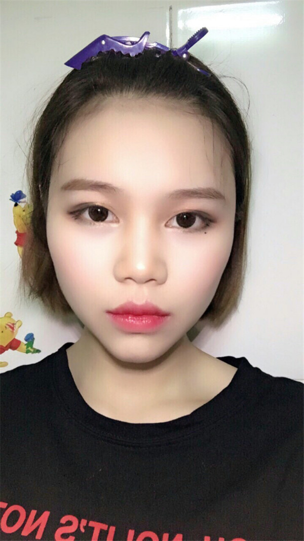姐妹们,你们喜欢M唇吗?我做了M唇和自体脂肪填充额头,大家都来看看,觉得我做的怎么样呢?