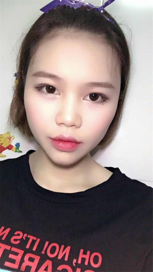 姐妹们,你们喜欢M唇吗?我做了M唇和自体脂肪填充额头,大家都来看看,觉得我做的怎么样呢?