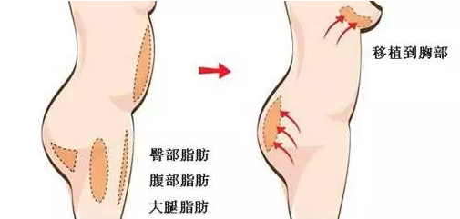 自体脂肪隆胸 VS 假体隆胸,你适合哪种?!