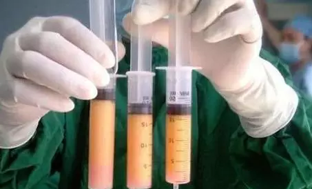 自体脂肪隆胸 VS 假体隆胸,你适合哪种?!