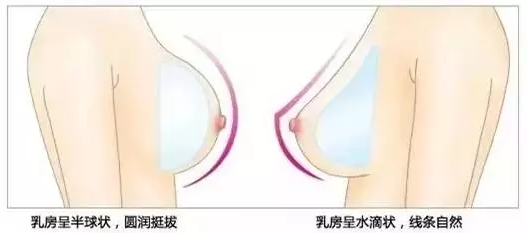 自体脂肪隆胸 VS 假体隆胸,你适合哪种?!