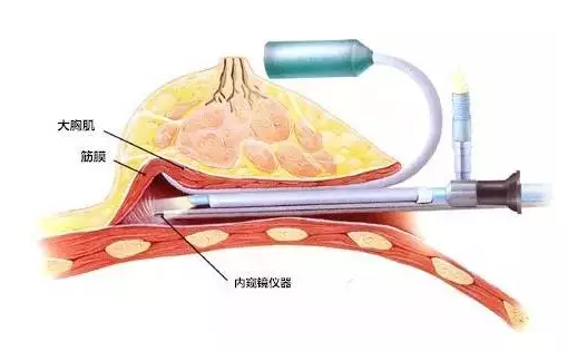 自体脂肪隆胸 VS 假体隆胸,你适合哪种?!