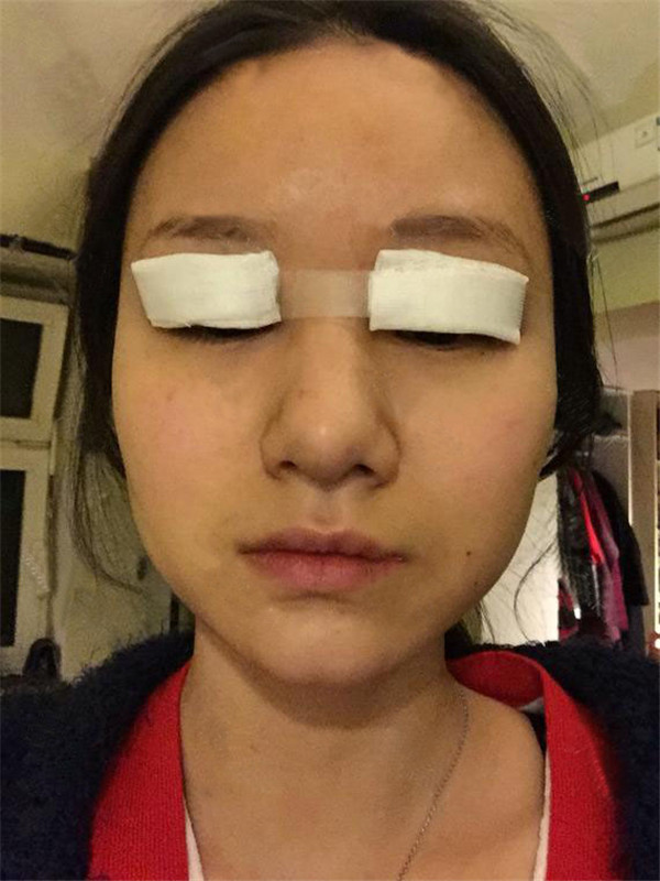做过双眼皮的宝宝们进来看看我的双眼皮案例吧!看看我的双眼皮做的怎么样?我觉得做啦双眼皮之后眼睛都大了一倍~~~