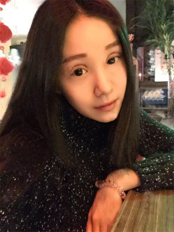 做过双眼皮的宝宝们进来看看我的双眼皮案例吧!看看我的双眼皮做的怎么样?我觉得做啦双眼皮之后眼睛都大了一倍~~~