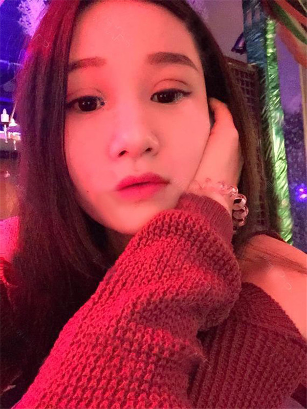 做过双眼皮的宝宝们进来看看我的双眼皮案例吧!看看我的双眼皮做的怎么样?我觉得做啦双眼皮之后眼睛都大了一倍~~~