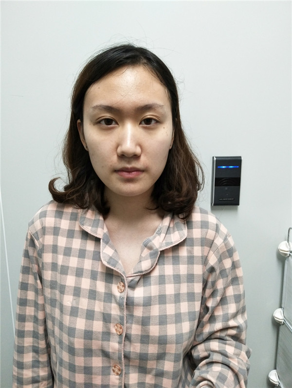冬天好冷啊,美女们进来看看我的假体隆鼻案例吧!对了较近有个佛系游戏 养娃 大家有没有玩过阿