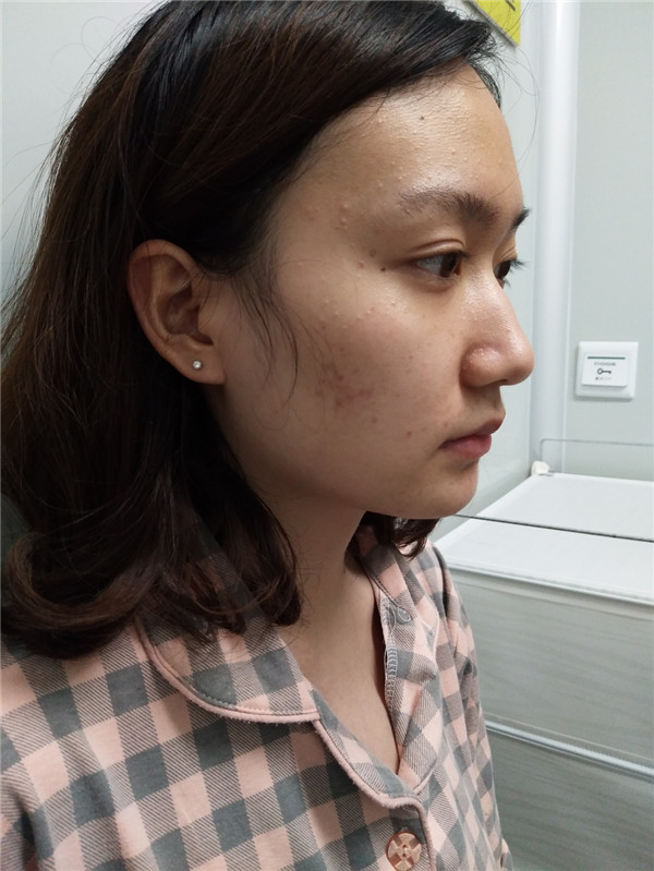 冬天好冷啊,美女们进来看看我的假体隆鼻案例吧!对了较近有个佛系游戏 养娃 大家有没有玩过阿