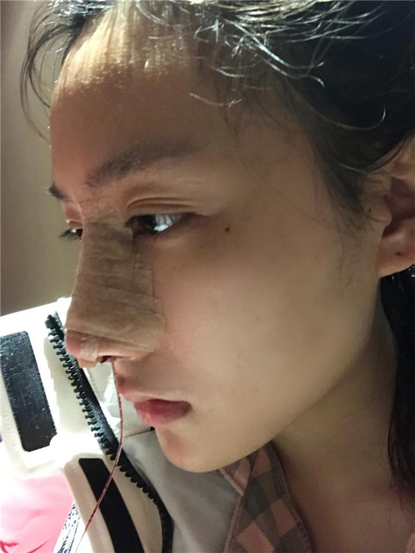 冬天好冷啊,美女们进来看看我的假体隆鼻案例吧!对了较近有个佛系游戏 养娃 大家有没有玩过阿