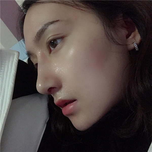 冬天好冷啊,美女们进来看看我的假体隆鼻案例吧!对了较近有个佛系游戏 养娃 大家有没有玩过阿