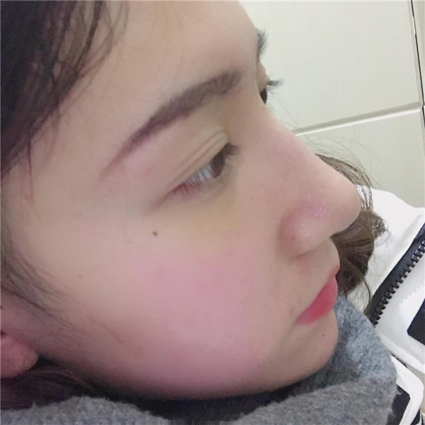 冬天好冷啊,美女们进来看看我的假体隆鼻案例吧!对了较近有个佛系游戏 养娃 大家有没有玩过阿