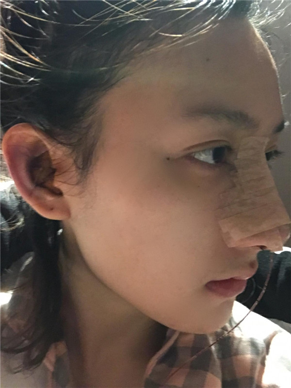 冬天好冷啊,美女们进来看看我的假体隆鼻案例吧!对了较近有个佛系游戏 养娃 大家有没有玩过阿
