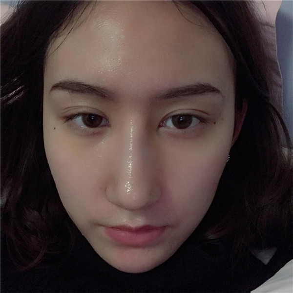 冬天好冷啊,美女们进来看看我的假体隆鼻案例吧!对了较近有个佛系游戏 养娃 大家有没有玩过阿