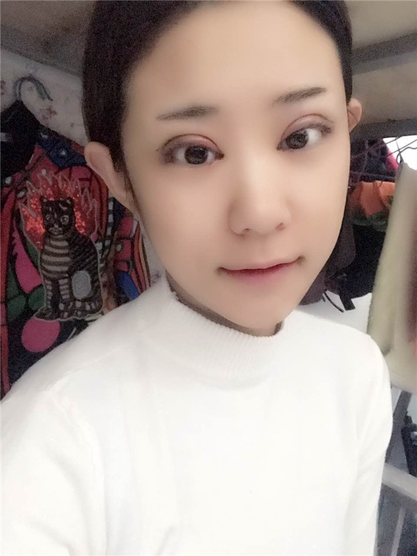 全切双眼皮加开眼角,小仙女们来看看我做的怎么样吧!有术后的照片哦~~