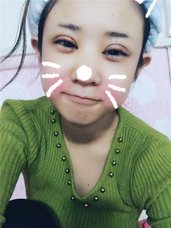 全切双眼皮加开眼角,小仙女们来看看我做的怎么样吧!有术后的照片哦~~