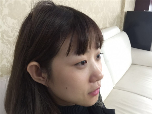 全切双眼皮加开眼角,小仙女们来看看我做的怎么样吧!有术后的照片哦~~