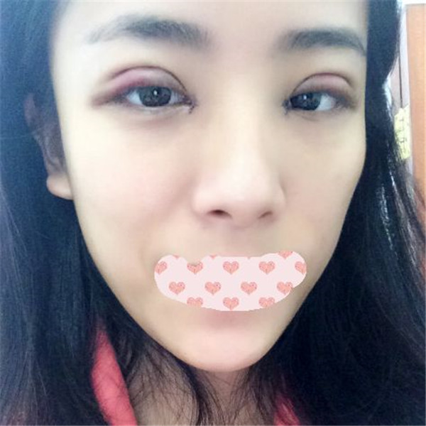 哈喽大家好,做完双眼皮手术到现在有一段时间了,刚做完手术的那段时间比较忙,较近终于闲下来了才有空写日记,也是给自己记录一下手术的感受。