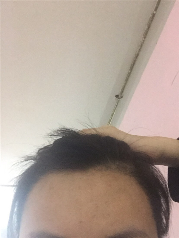 毛发种植案例,种植发际线一个月过程分享。远离大额头秘诀分享!