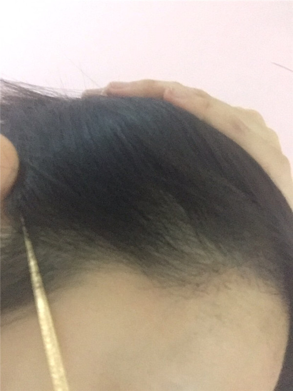 毛发种植案例,种植发际线一个月过程分享。远离大额头秘诀分享!