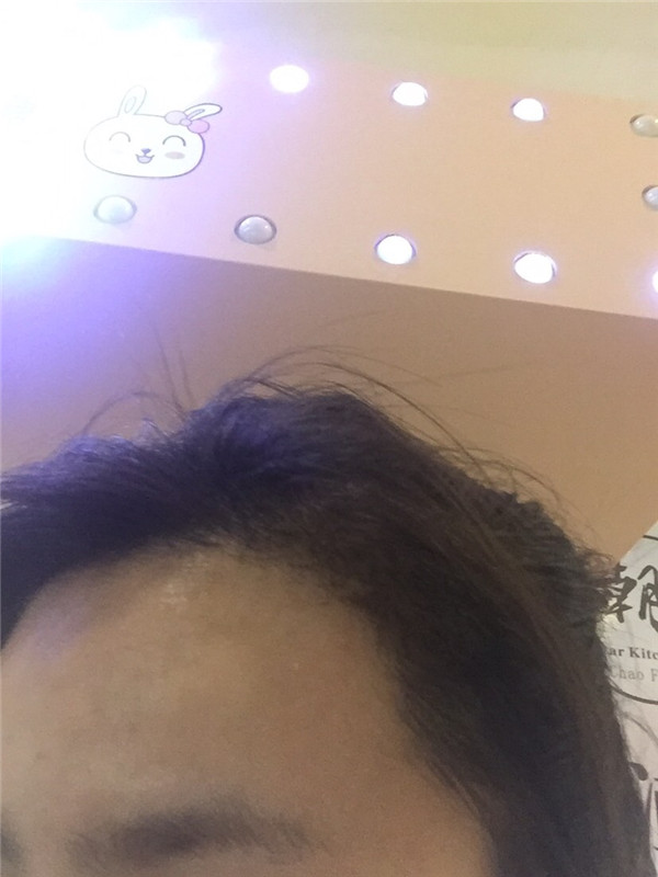 毛发种植案例,种植发际线一个月过程分享。远离大额头秘诀分享!