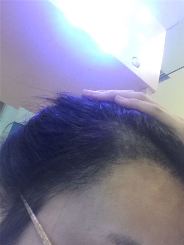 毛发种植案例,种植发际线一个月过程分享。远离大额头秘诀分享!