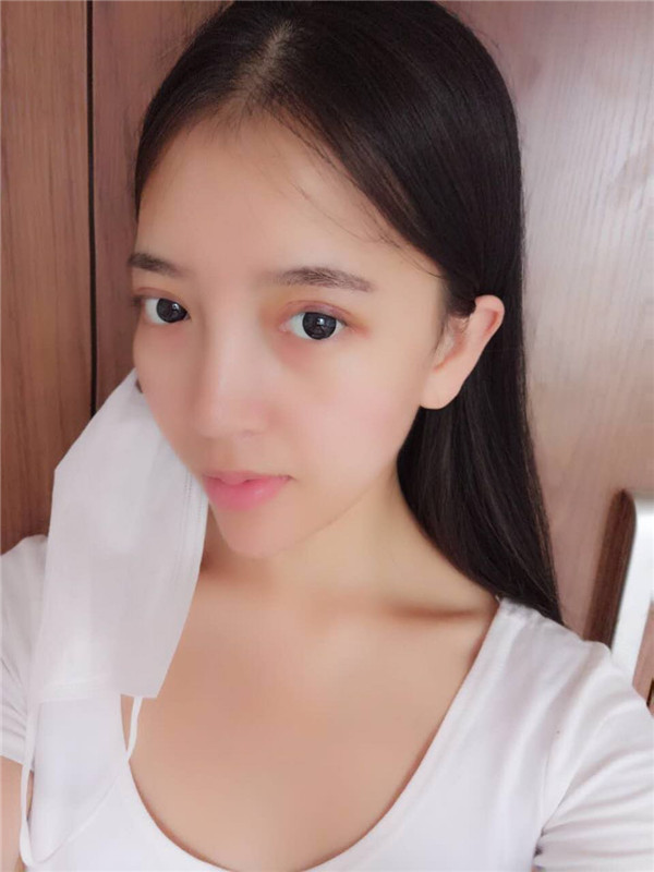 姐妹们,我去做了双眼皮手术!趁着过年好好恢复,宝宝们有没有和我一样做双眼皮的,快传授点有助恢复的方法给我吧~~~