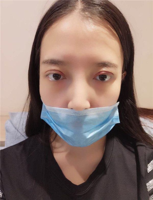 姐妹们,我去做了双眼皮手术!趁着过年好好恢复,宝宝们有没有和我一样做双眼皮的,快传授点有助恢复的方法给我吧~~~