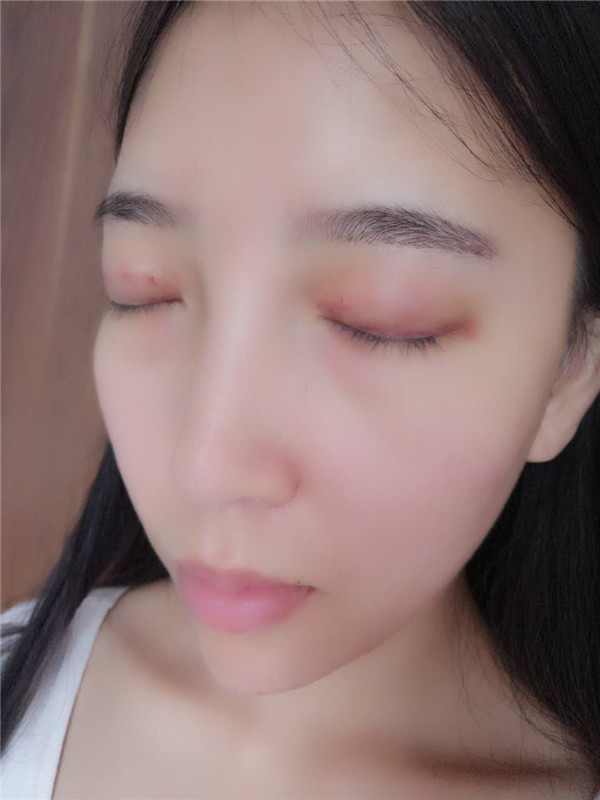 姐妹们,我去做了双眼皮手术!趁着过年好好恢复,宝宝们有没有和我一样做双眼皮的,快传授点有助恢复的方法给我吧~~~