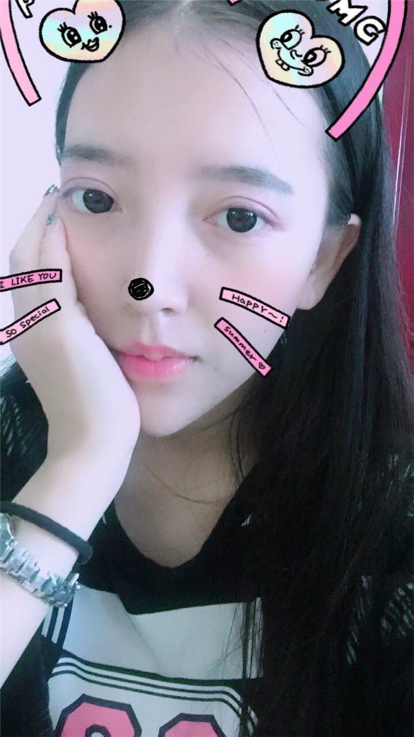 姐妹们,我去做了双眼皮手术!趁着过年好好恢复,宝宝们有没有和我一样做双眼皮的,快传授点有助恢复的方法给我吧~~~