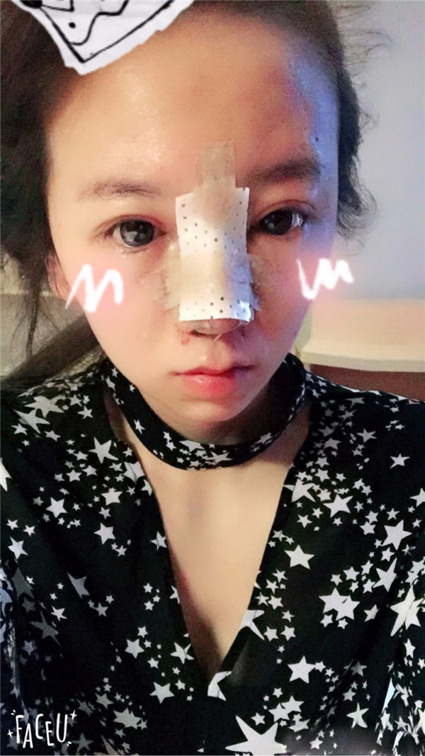 给姐妹们看看我的鼻部手术案例啦,我的鼻子恢复的很好,大家可不要羡慕我哦,哈哈哈哈,下面给大家看看我的隆鼻经历!哇咔咔,嘿嘿~~~~