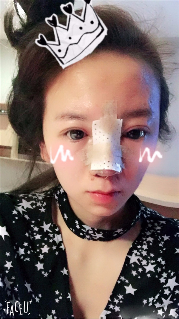给姐妹们看看我的鼻部手术案例啦,我的鼻子恢复的很好,大家可不要羡慕我哦,哈哈哈哈,下面给大家看看我的隆鼻经历!哇咔咔,嘿嘿~~~~