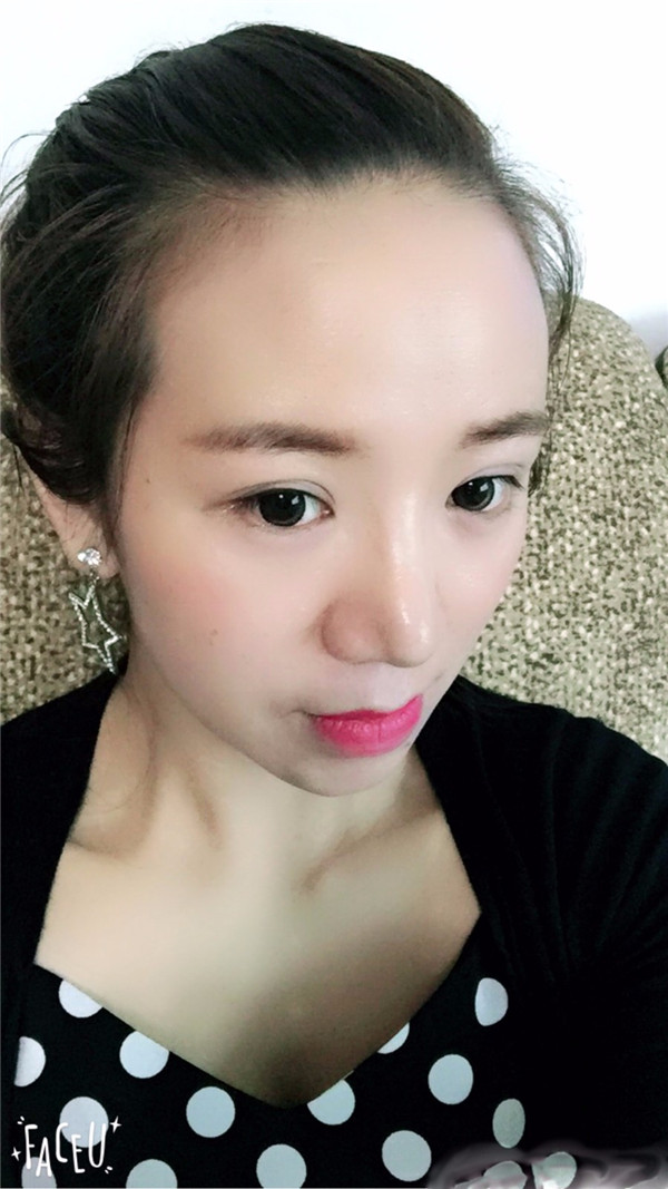 给姐妹们看看我的鼻部手术案例啦,我的鼻子恢复的很好,大家可不要羡慕我哦,哈哈哈哈,下面给大家看看我的隆鼻经历!哇咔咔,嘿嘿~~~~