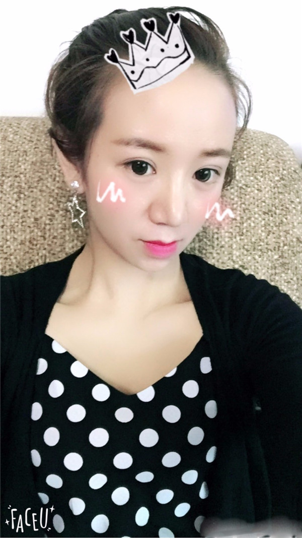 给姐妹们看看我的鼻部手术案例啦,我的鼻子恢复的很好,大家可不要羡慕我哦,哈哈哈哈,下面给大家看看我的隆鼻经历!哇咔咔,嘿嘿~~~~
