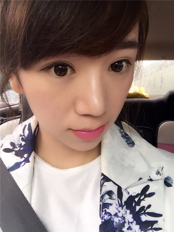 给姐妹们看看我的鼻部手术案例啦,我的鼻子恢复的很好,大家可不要羡慕我哦,哈哈哈哈,下面给大家看看我的隆鼻经历!哇咔咔,嘿嘿~~~~